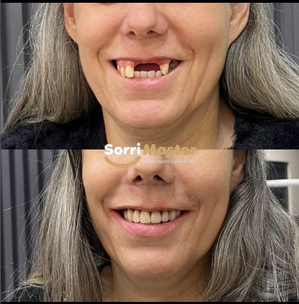 Antes e depois: reabilitação do sorriso na Sorri Master