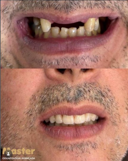 Antes e depois: implantes e prótese na Sorri Master