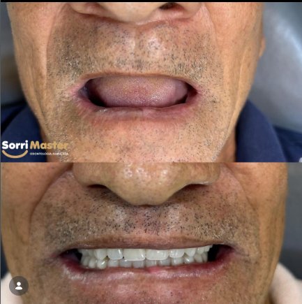 Antes e depois: reabilitação oral na Sorri Master